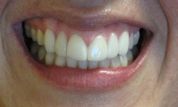 After: Crowns and In-Office Whitening