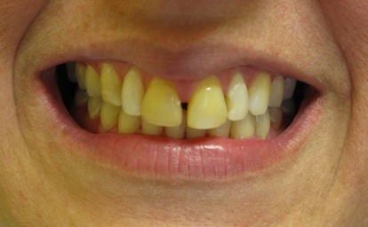 Before: Spaces and discolored teeth