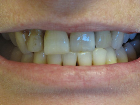 Before: Cracked, decay and discolored teeth