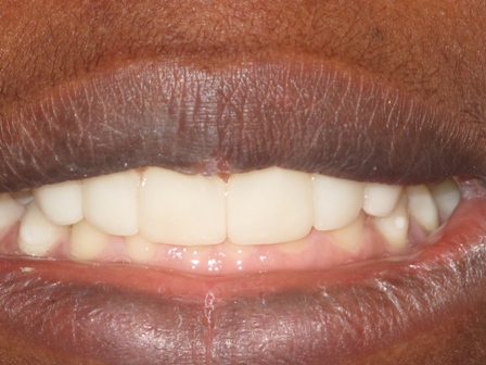 After: Veneers and In-Office whitening