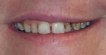 Before: Spaces, decay and discolored teeth