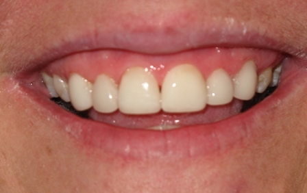 After: Crowns and Veneers