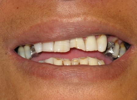 Before: Worn, chipped, defective fillings, cracked and missing teeth