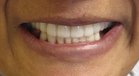 Crown, bridges and veneers